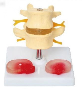 兩節(jié)腰椎帶兩個病變椎間盤模型