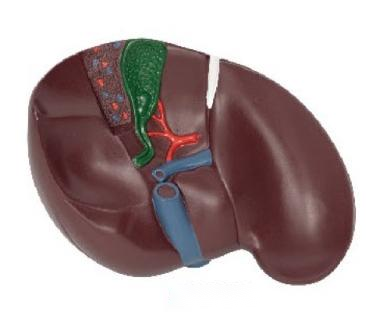 肝膽結石模型