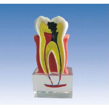 齲齒解剖模型